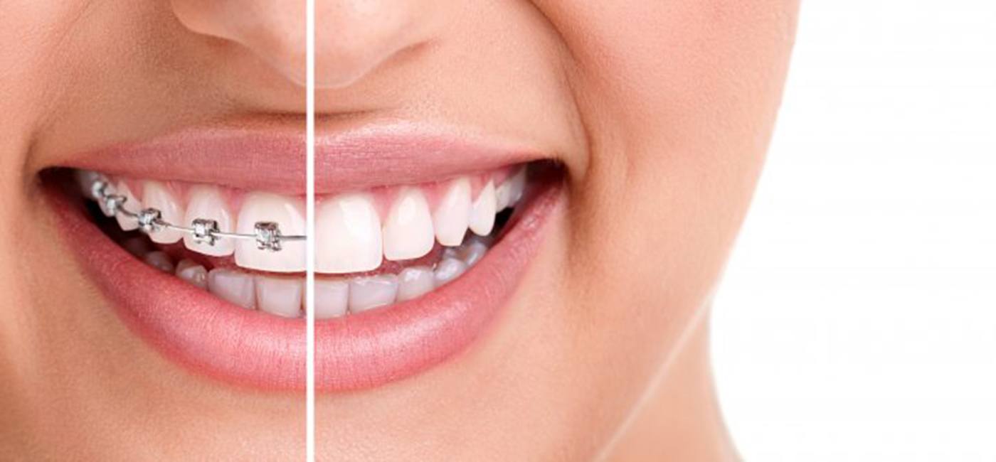 Before after of a patient’s traditional braces treatment