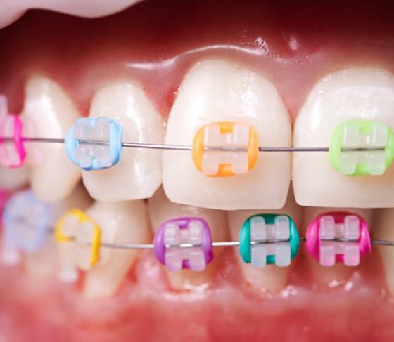 Crooked teeth with braces that have colorful elastics