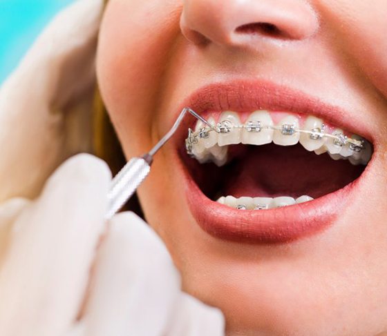 Dentist cleaning a patient’s braces during a checkup & cleaning