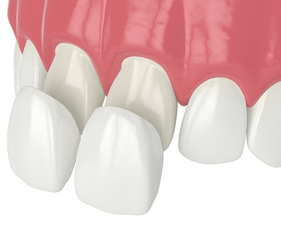 Up-close view of dental veneers