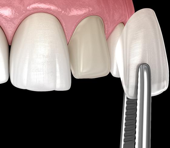 Digital image of a veneer being placed over the surface of a tooth