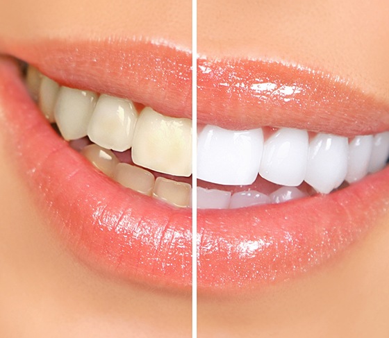 Before and after image of stained and whiter teeth